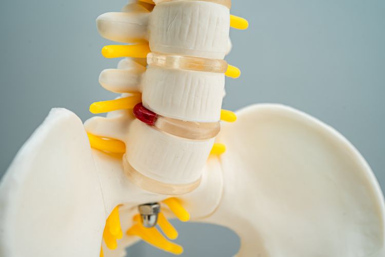 Decoding Herniated Discs: A Spinal Dilemma
