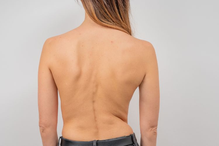 Straightening the Curve- Upper Cervical Chiropractic’s Role in Scoliosis Management