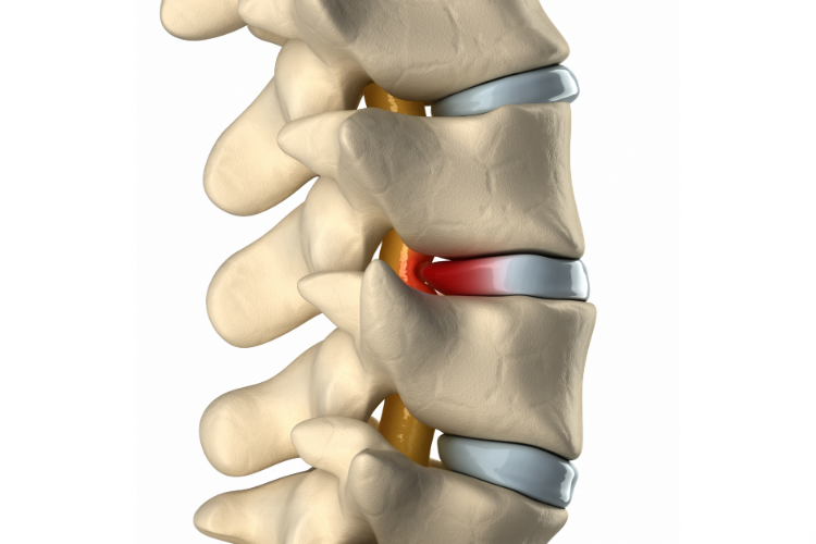 Opening New Pathways: Upper Cervical Chiropractic’s Role in Managing Spinal Stenosis